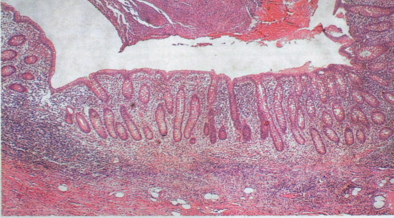 急性蜂窝阑尾炎红蓝图图片